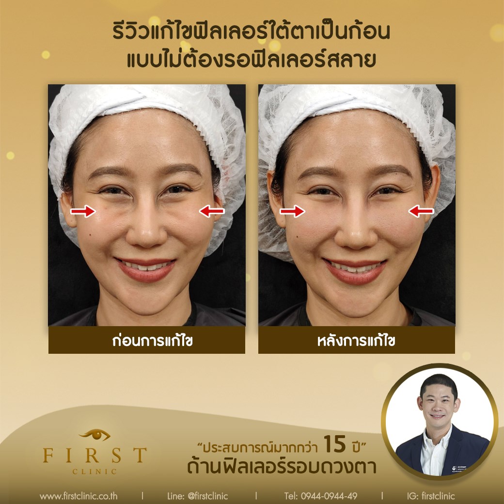 ใต้ตาเป็นก้อน