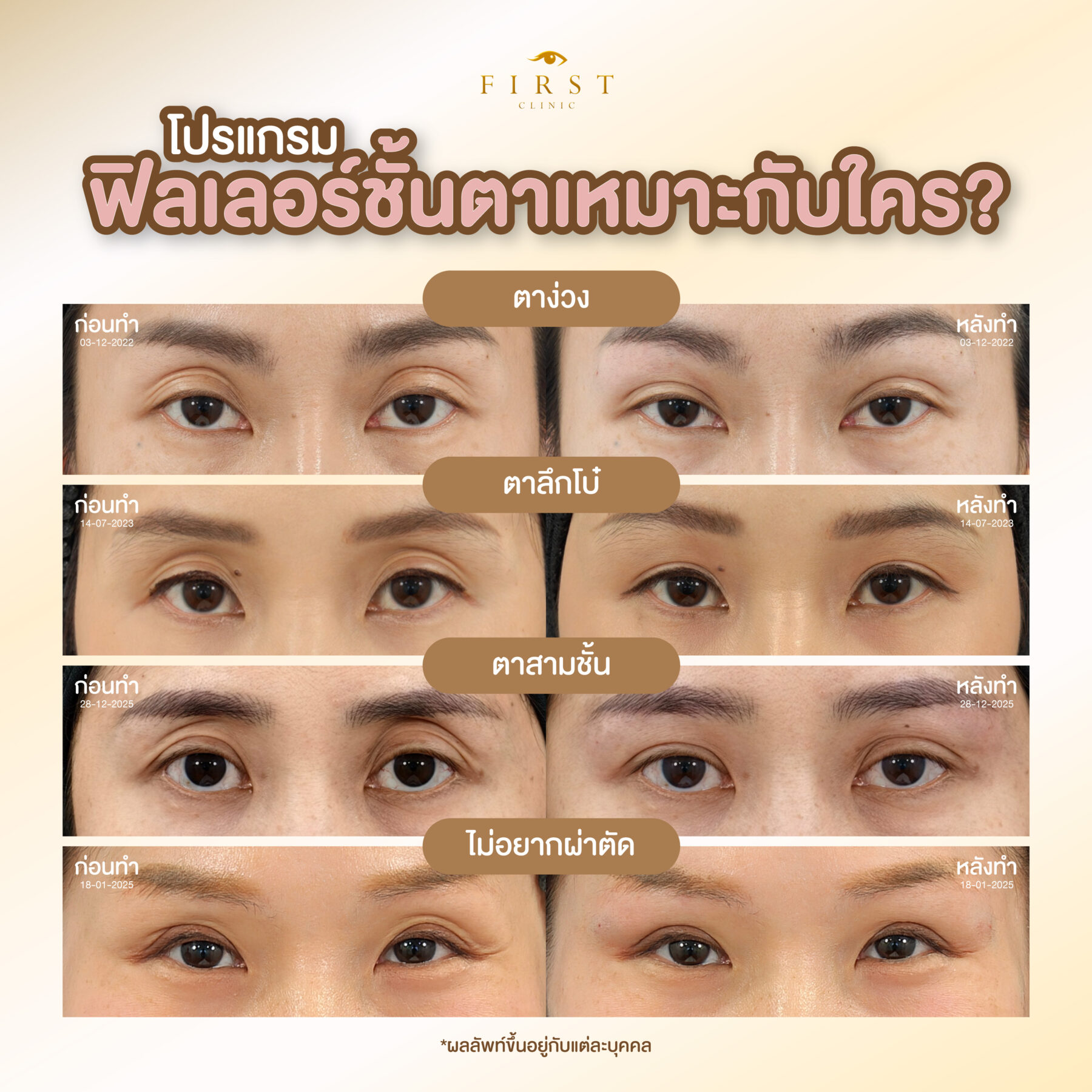 ใครฉีดฟิลเลอร์ตาสองชั้นได้บ้าง