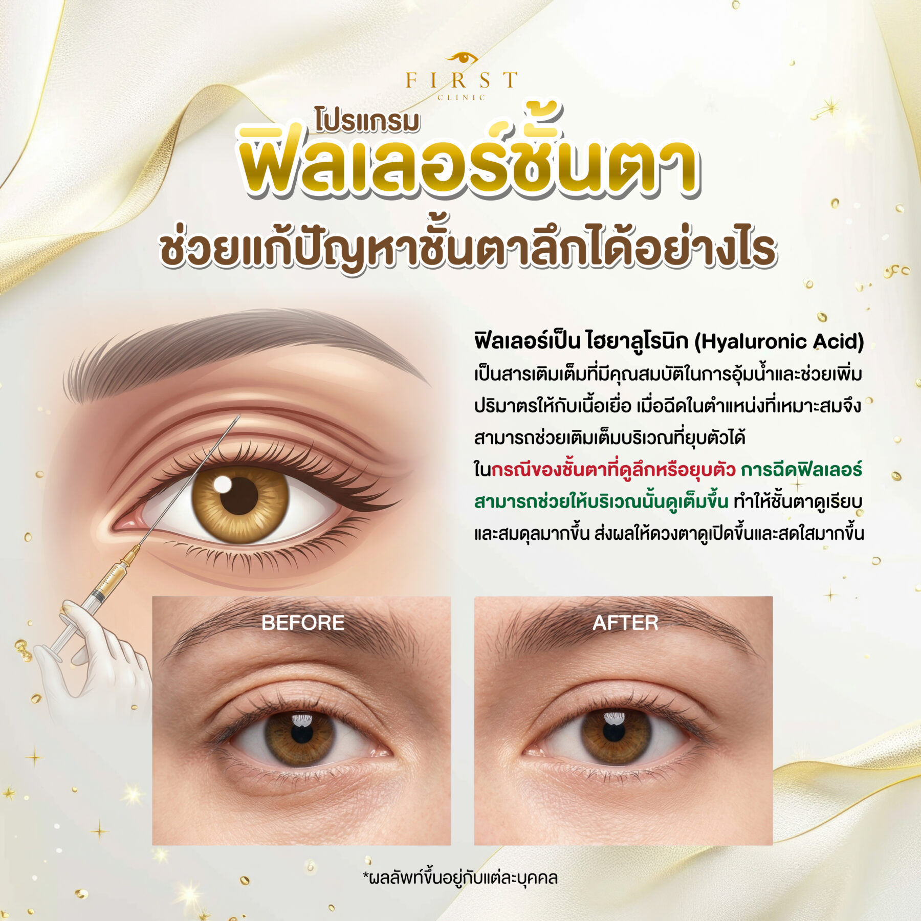 ฟิลเลอร์ชั้นตา